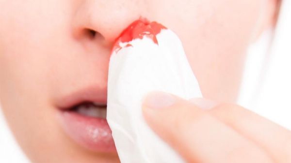 Bệnh xì mũi ra máu - Triệu chứng, nguyên nhân và cách điều trị