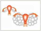 Hội chứng quá kích buồng trứng - Triệu chứng, nguyên nhân và cách điều trị