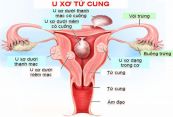 Bệnh u xơ tử cung (nhân xơ tử cung) - Triệu chứng, nguyên nhân và cách điều trị