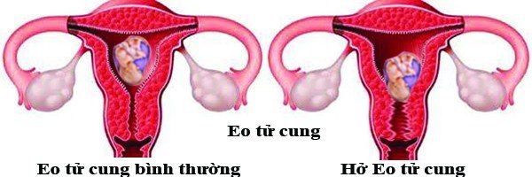 Bệnh hở eo tử cung - Triệu chứng, nguyên nhân và cách điều trị