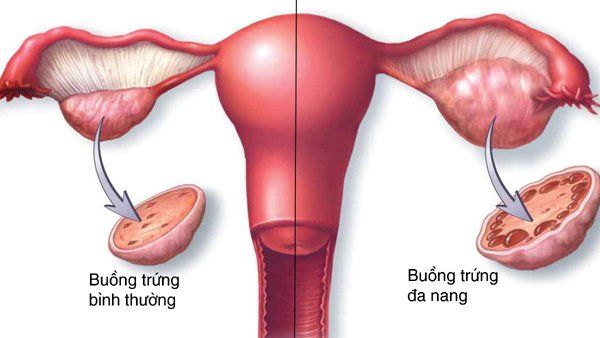 Hội chứng buồng trứng đa nang - Triệu chứng, nguyên nhân và cách điều trị