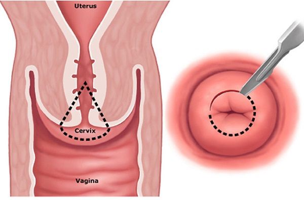 Khoét chóp cổ tử cung - Những thông tin cần biết