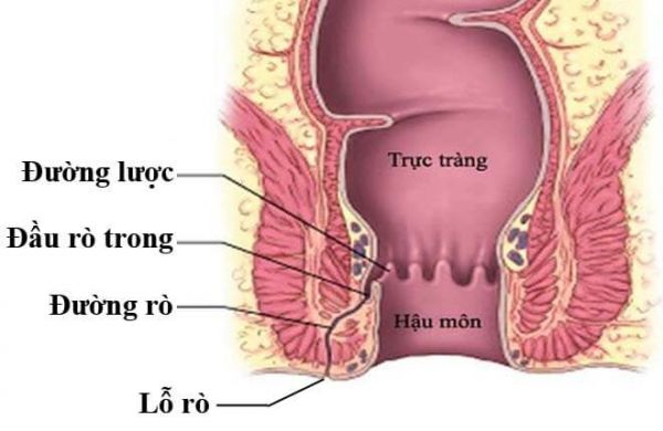 Bệnh lỗ rò âm đạo trực tràng - Triệu chứng, nguyên nhân và cách điều trị