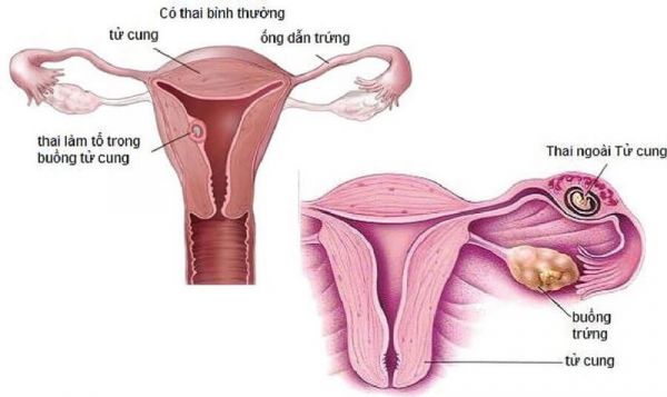 Mang thai ngoài tử cung - Triệu chứng, nguyên nhân và cách điều trị