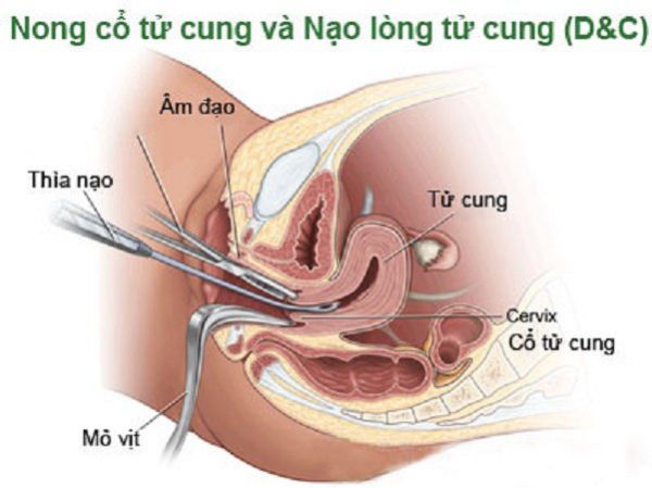 Nong và nạo tử cung - Những thông tin cần biết