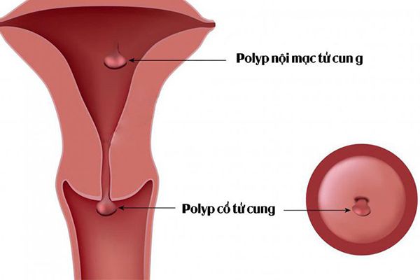 Bệnh polyp cổ tử cung  - Triệu chứng, nguyên nhân và cách điều trị