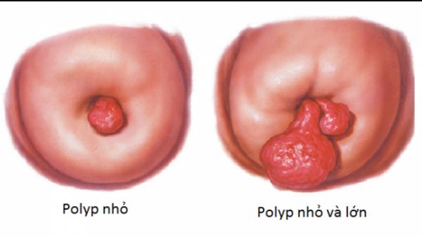 Bệnh polyp tử cung - Triệu chứng, nguyên nhân và cách điều trị