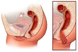 Bệnh sa tử cung (Sa sinh dục) - Triệu chứng, nguyên nhân và cách điều trị