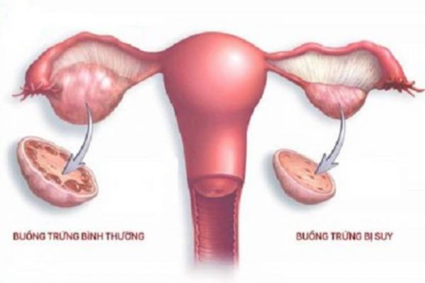 Bệnh suy buồng trứng sớm - Triệu chứng, nguyên nhân và cách điều trị