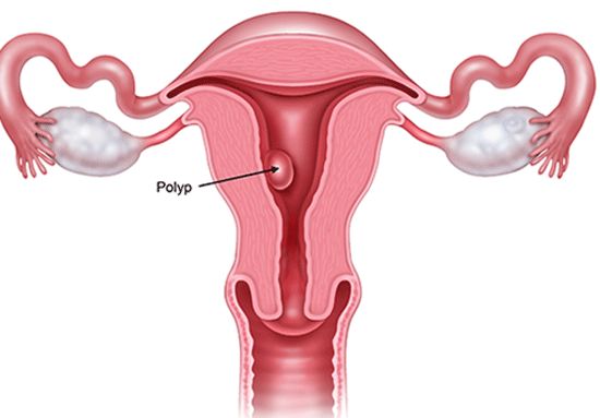Bệnh tăng sản nội mạc tử cung - Triệu chứng, nguyên nhân và cách điều trị