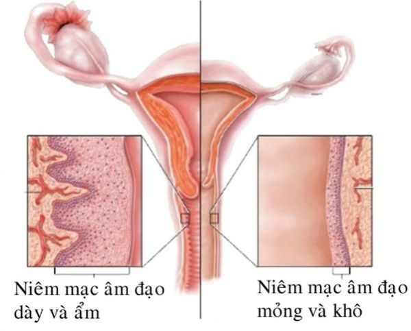 Bệnh teo âm đạo - Triệu chứng, nguyên nhân và cách điều trị