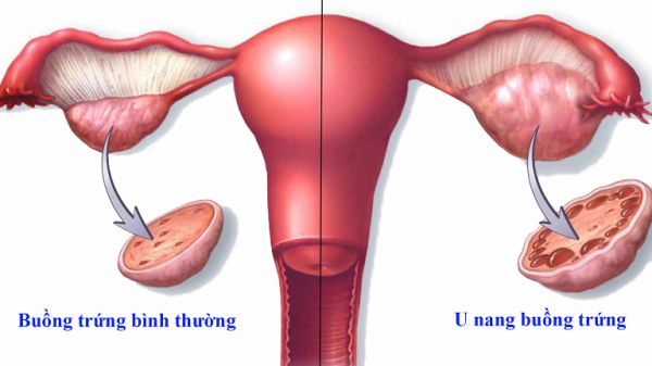 Bệnh u nang buồng trứng - Triệu chứng, chẩn đoán và điều trị