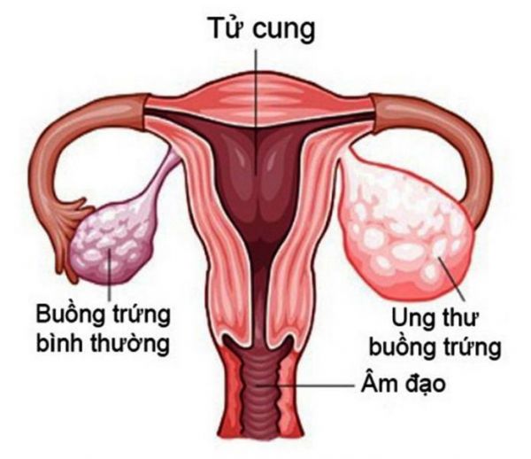 Bệnh ung thư buồng trứng - Triệu chứng, nguyên nhân và cách điều trị