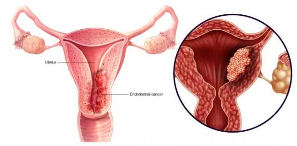 Bệnh ung thư tử cung - Triệu chứng, nguyên nhân và cách điều trị