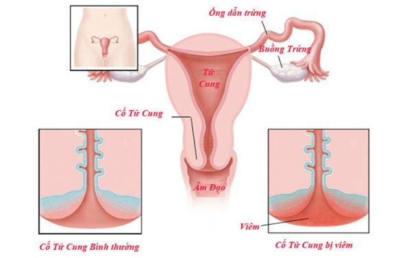 Bệnh viêm âm đạo do nấm - triệu chứng, nguyên nhân và cách điều trị