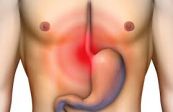 Bệnh loét thực quản - Triệu chứng, nguyên nhân và cách điều trị