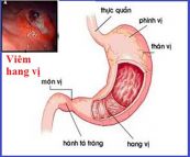 Bệnh viêm hang vị dạ dày - Triệu chứng, nguyên nhân và cách điều trị