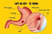 Bệnh viêm loét dạ dày tá tràng - Triệu chứng, nguyên nhân và cách điều trị