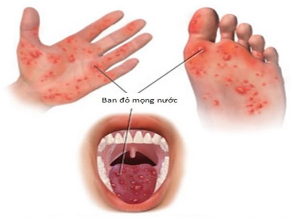 Bệnh tay chân miệng - Triệu chứng, nguyên nhân và cách điều trị