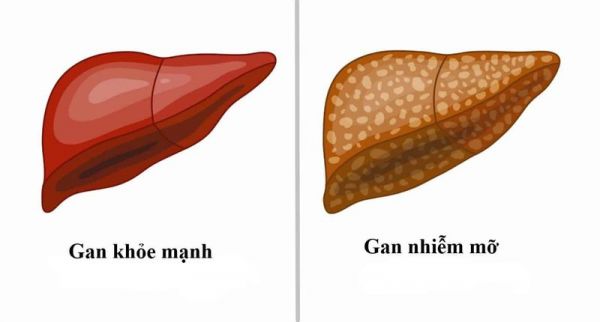 Bệnh gan nhiễm mỡ - triệu chứng, nguyên nhân và cách điều trị