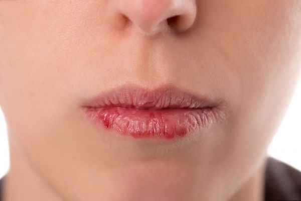 Bệnh khô miệng - Triệu chứng, nguyên nhân và cách điều trị