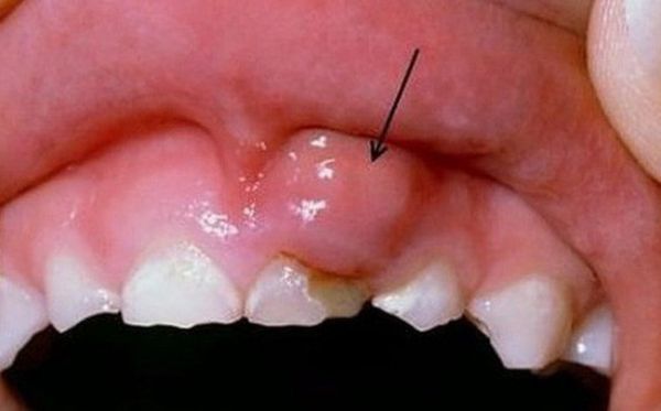 Bệnh ung thư miệng - Triệu chứng, nguyên nhân và cách điều trị