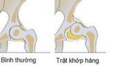 Bệnh trật khớp háng - Triệu chứng, nguyên nhân và cách điều trị