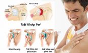 Bệnh trật khớp vai - Triệu chứng, nguyên nhân và cách điều trị