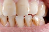 Tự kiểm tra vôi răng - Những thông tin cần biết