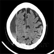 Bệnh tụ máu dưới màng cứng - Triệu chứng, nguyên nhân và cách điều trị