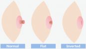Bệnh tụt núm vú - Triệu chứng, nguyên nhân và cách điều trị