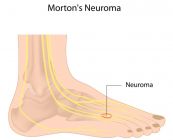 Bệnh u dây thần kinh Morton - Triệu chứng, nguyên nhân và cách điều trị