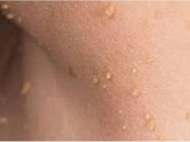 Bệnh u hạt bẹn - triệu chứng, nguyên nhân và cách điều trị