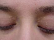 Bệnh u hạt vành - Triệu chứng, nguyên nhân và cách điều trị