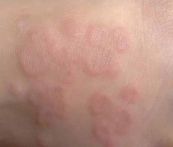 Bệnh u hạt vòng - triệu chứng, nguyên nhân và cách điều trị