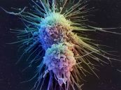 Bệnh u lympho tế bào T - triệu chứng, nguyên nhân và cách điều trị
