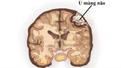 Bệnh u màng não - triệu chứng, nguyên nhân và cách điều trị