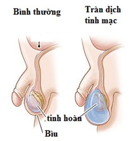 Bệnh tràn dịch tinh mạc - Triệu chứng, nguyên nhân và cách điều trị