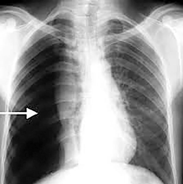 Bệnh tràn khí màng phổi - Triệu chứng, nguyên nhân và cách điều trị