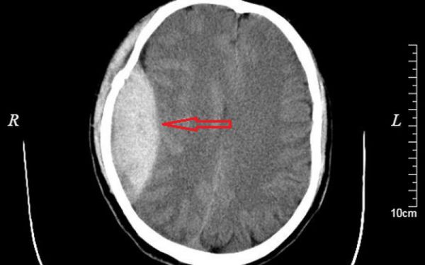 Bệnh tụ máu ngoài màng cứng - Triệu chứng, nguyên nhân và cách điều trị