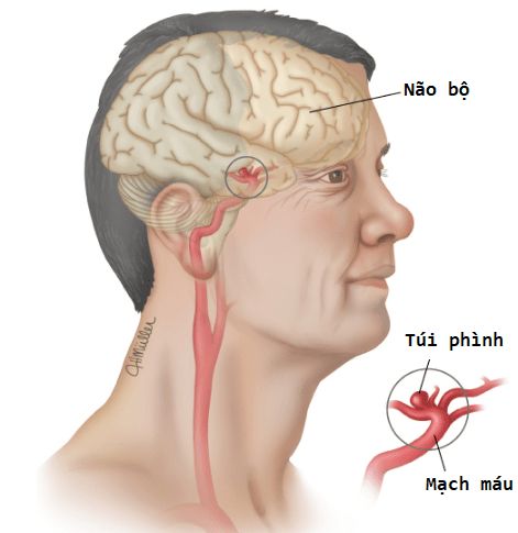 Bệnh túi phình mạch máu não - Triệu chứng, nguyên nhân và cách điều trị