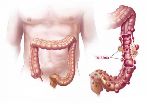 Bệnh túi thừa - Triệu chứng, nguyên nhân và cách điều trị