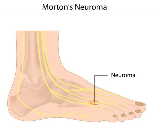 Bệnh u dây thần kinh Morton - Triệu chứng, nguyên nhân và cách điều trị