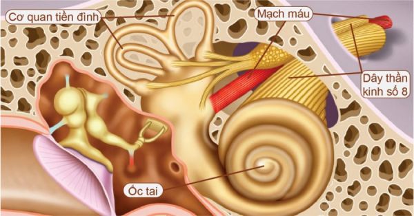 Bệnh u dây thần kinh thính giác - Triệu chứng, nguyên nhân và cách điều trị