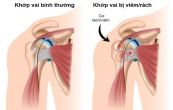 Bệnh thoái hóa khớp vai - Triệu chứng, nguyên nhân và cách điều trị