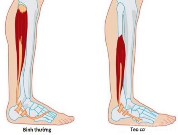 Bệnh teo cơ - triệu chứng, nguyên nhân và cách điều trị