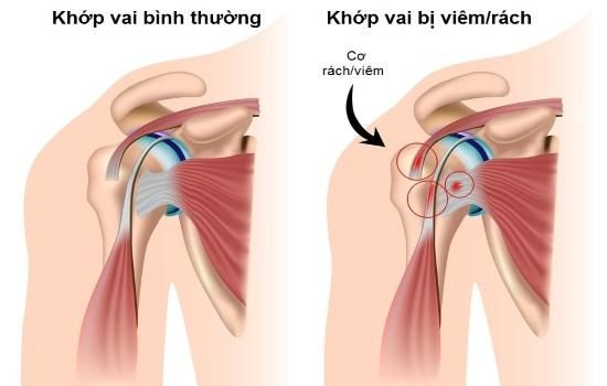 Bệnh thoái hóa khớp vai - Triệu chứng, nguyên nhân và cách điều trị