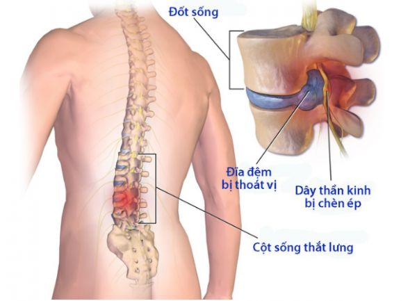 Bệnh thoát vị đĩa đệm thắt lưng - Triệu chứng, nguyên nhân và cách điều trị