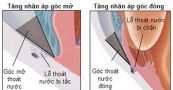 Bệnh tăng nhãn áp góc đóng nguyên phát - Triệu chứng, nguyên nhân và cách điều trị