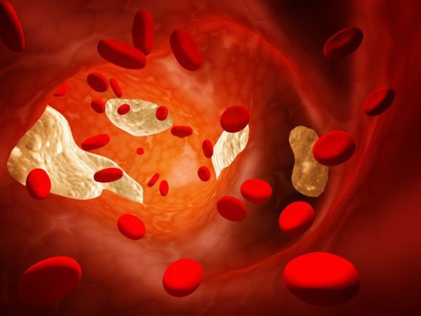 Bệnh tăng cholesterol máu thuần túy - Triệu chứng, nguyên nhân và cách điều trị